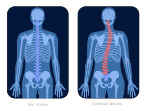 combined-scoliosis-on-x-ray-vector-illustration-spine-curvatures-and-healthy-backbone_206049-1777